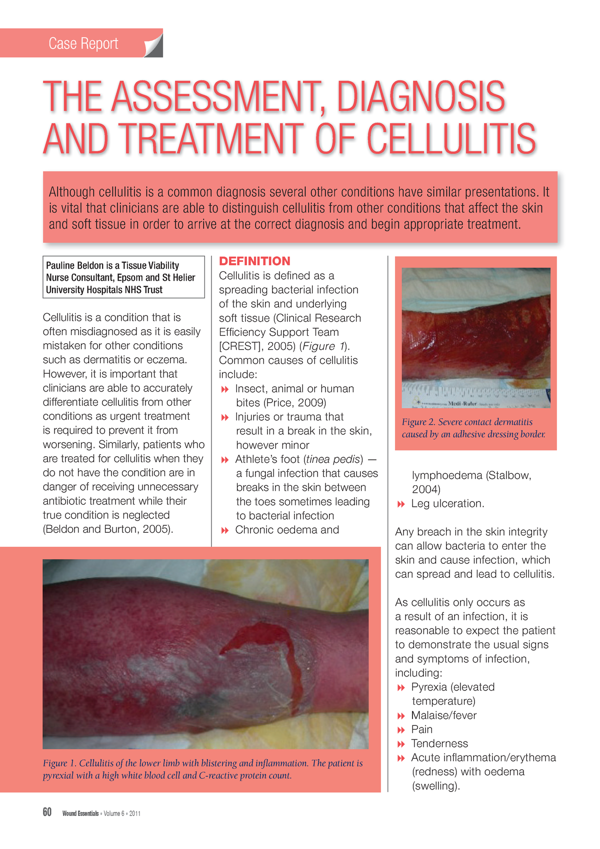 Wound essentials 6 the assessment diagnosis and treatment of cellulitis