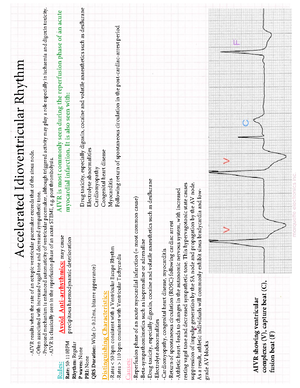 PVC - EKG information - ... Premature Ventricular Complex (PVC) A ...