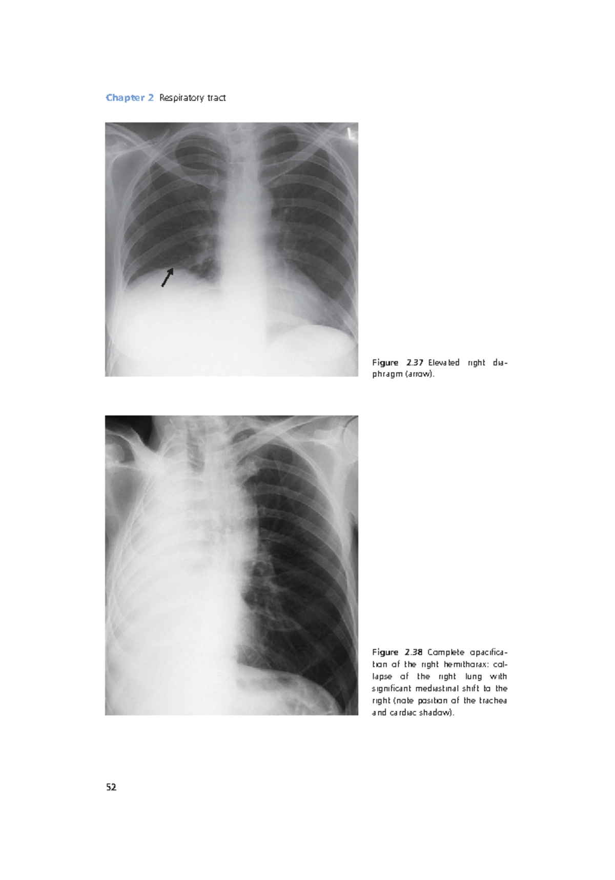 Radiology Lecture Notes pdf (18) - Chapter 2 Respiratory tract 52 ...