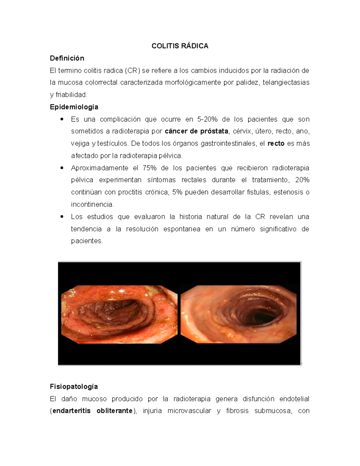 enema de próstata con radiación