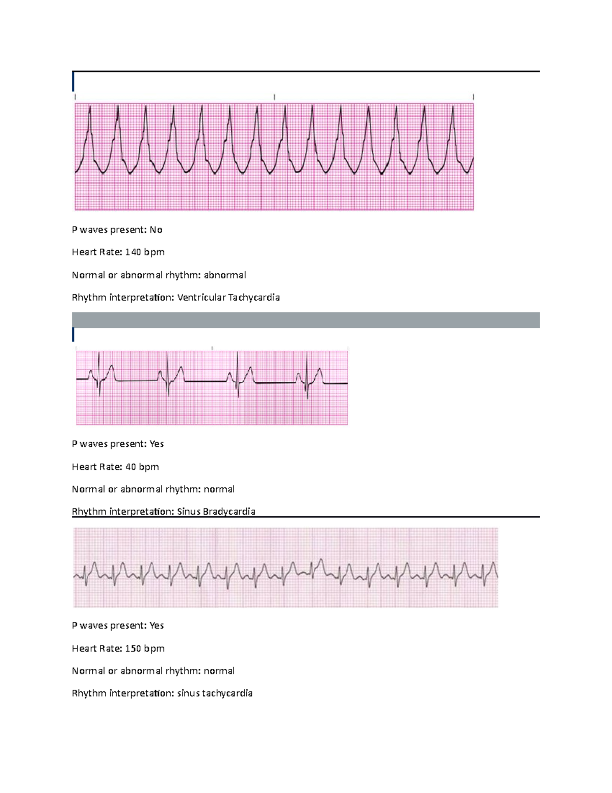 EKG Packet HW 2023 - P waves present: No Heart Rate: 140 bpm Normal or ...