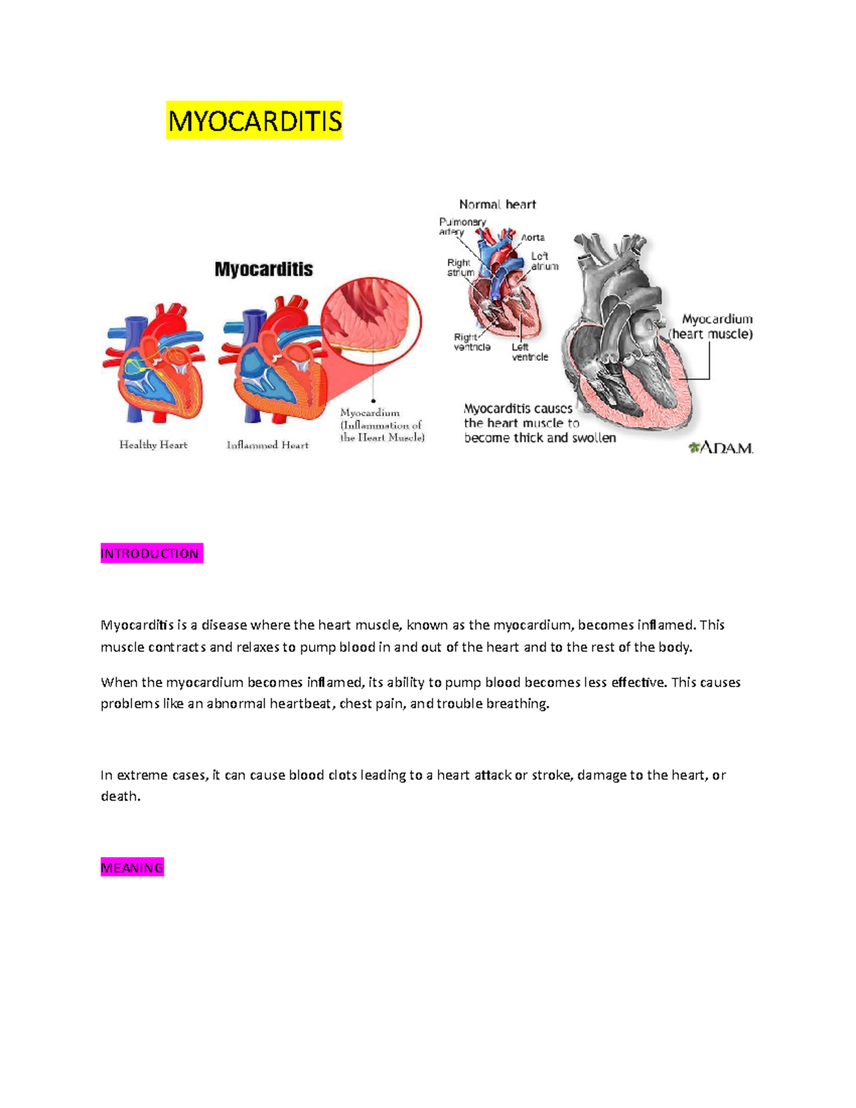 Myocarditis-WPS Office - MYOCARDITIS INTRODUCTION Myocarditis is a ...