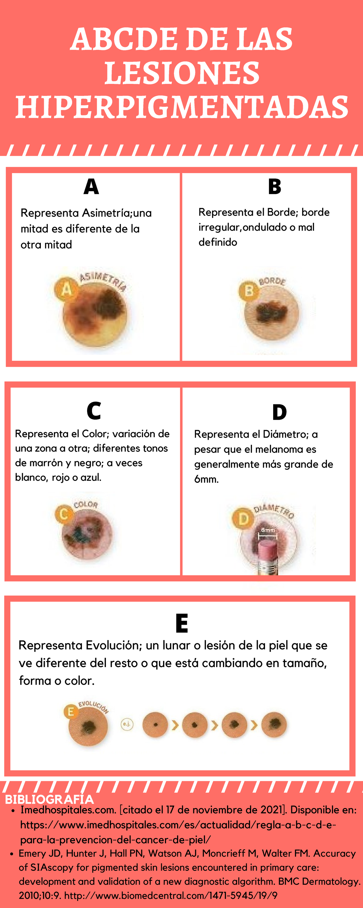 Abcde De Las Lesiones Hiperpigmentadas - ABCDE DE LAS LESIONES ...