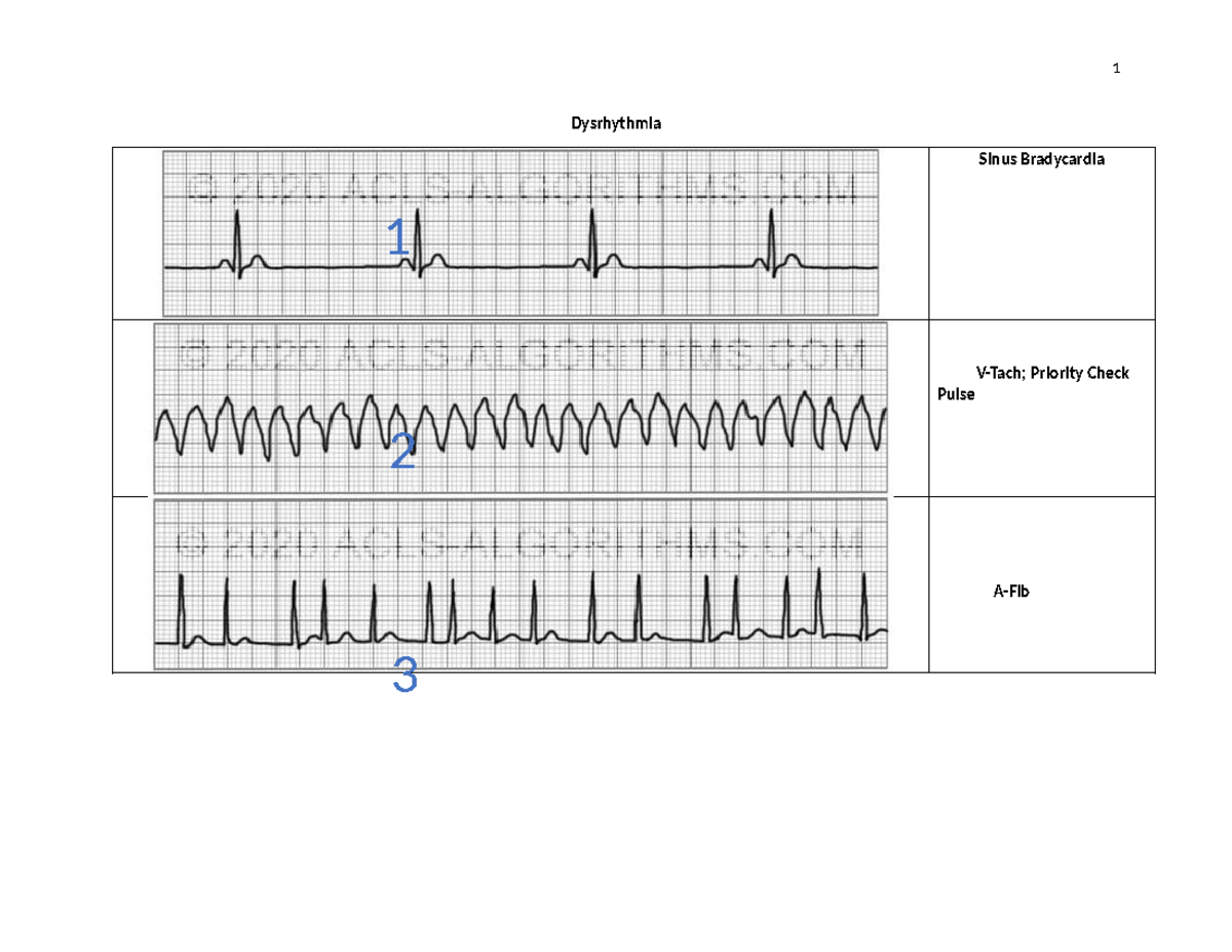 Dysrhythmia workshee - ecg strips - Dysrhythmia Sinus Bradycardia V ...