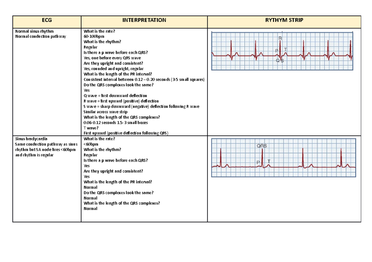 ECG Rhythms And Interpretation - ECG INTERPRETATION RYTHYM STRIP Normal ...