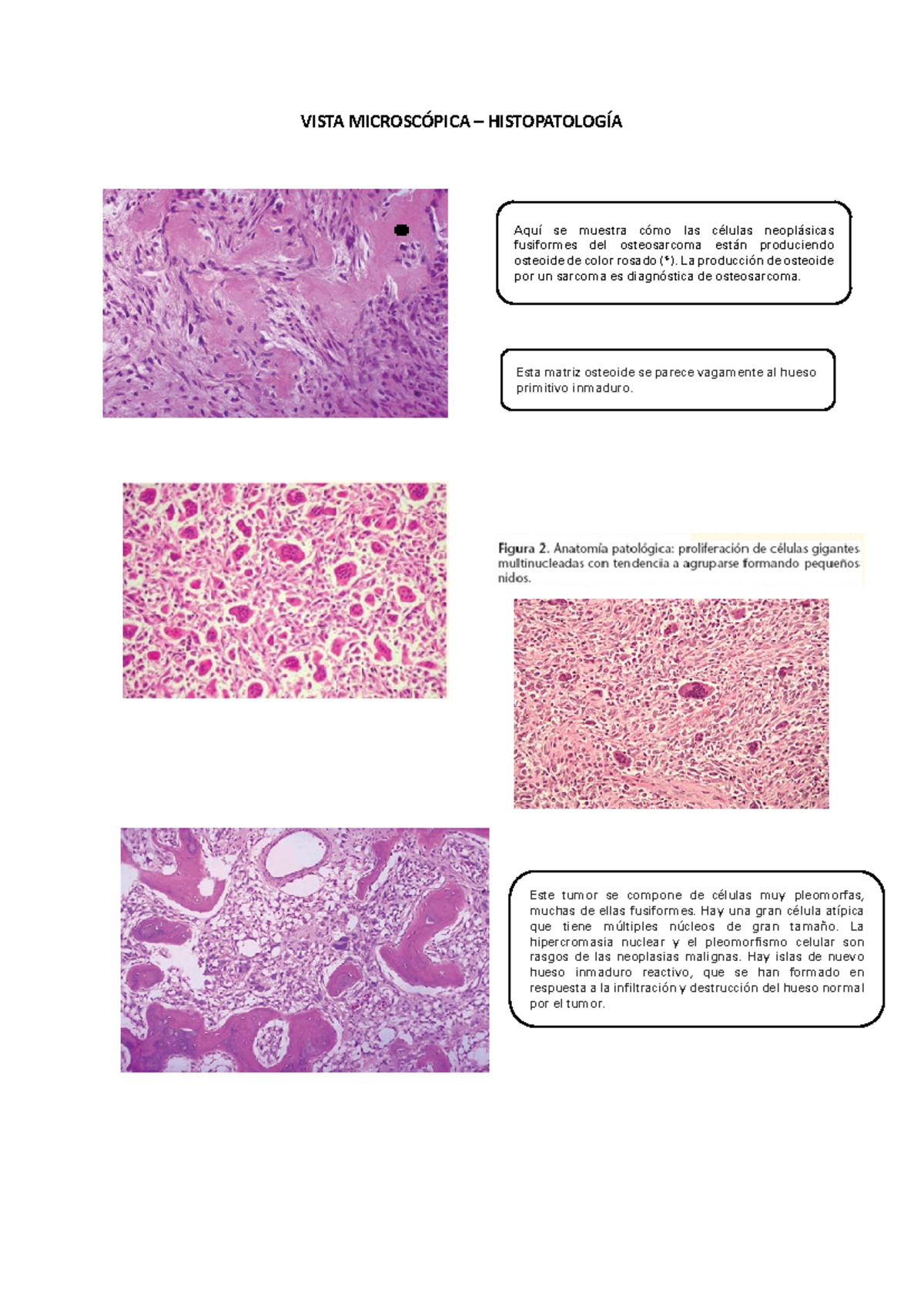 Osteosarcoma - Histopatología - VISTA MICROSCÓPICA – HISTOPATOLOGÍA ...