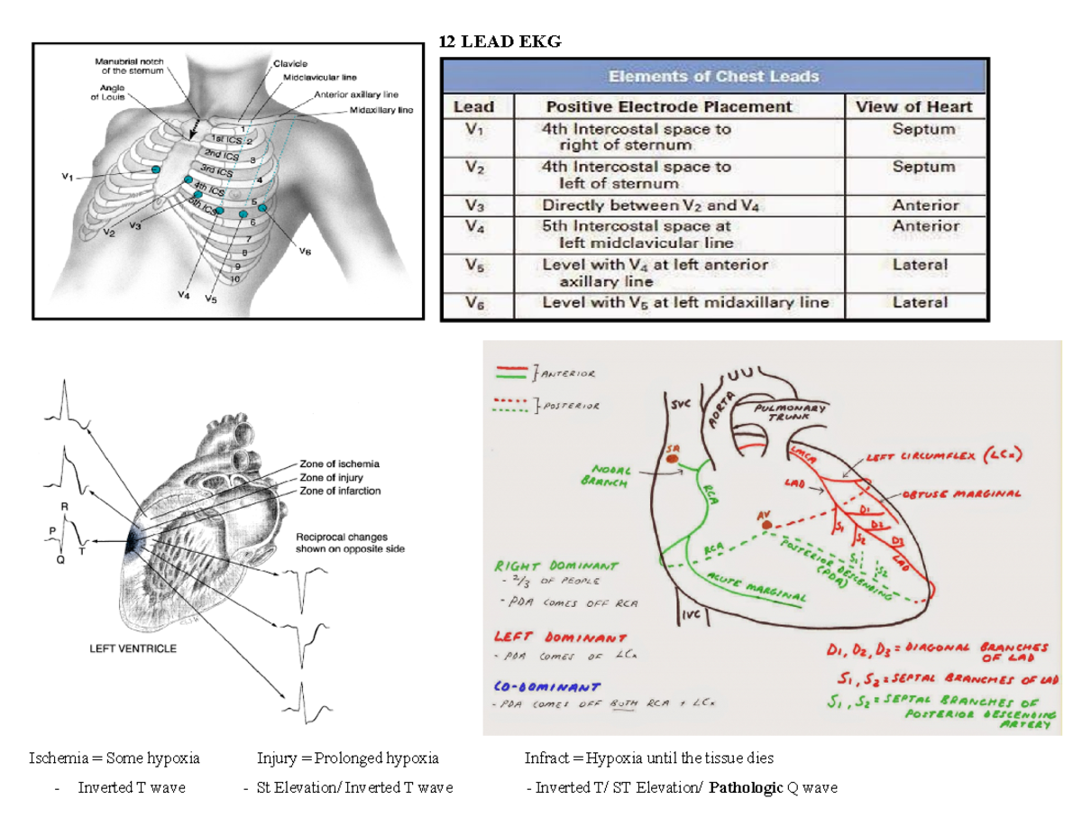 12 LEAD EKG - EKG - 12 LEAD EKG Ischemia = Some hypoxia Injury ...