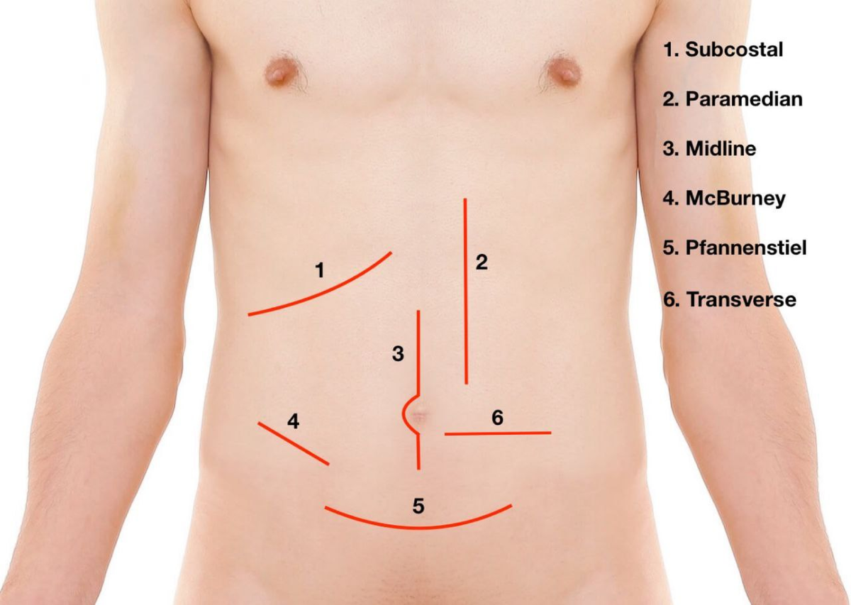 Incisions - Anatomy, Embeyology, Arthology, Angiology - Studocu