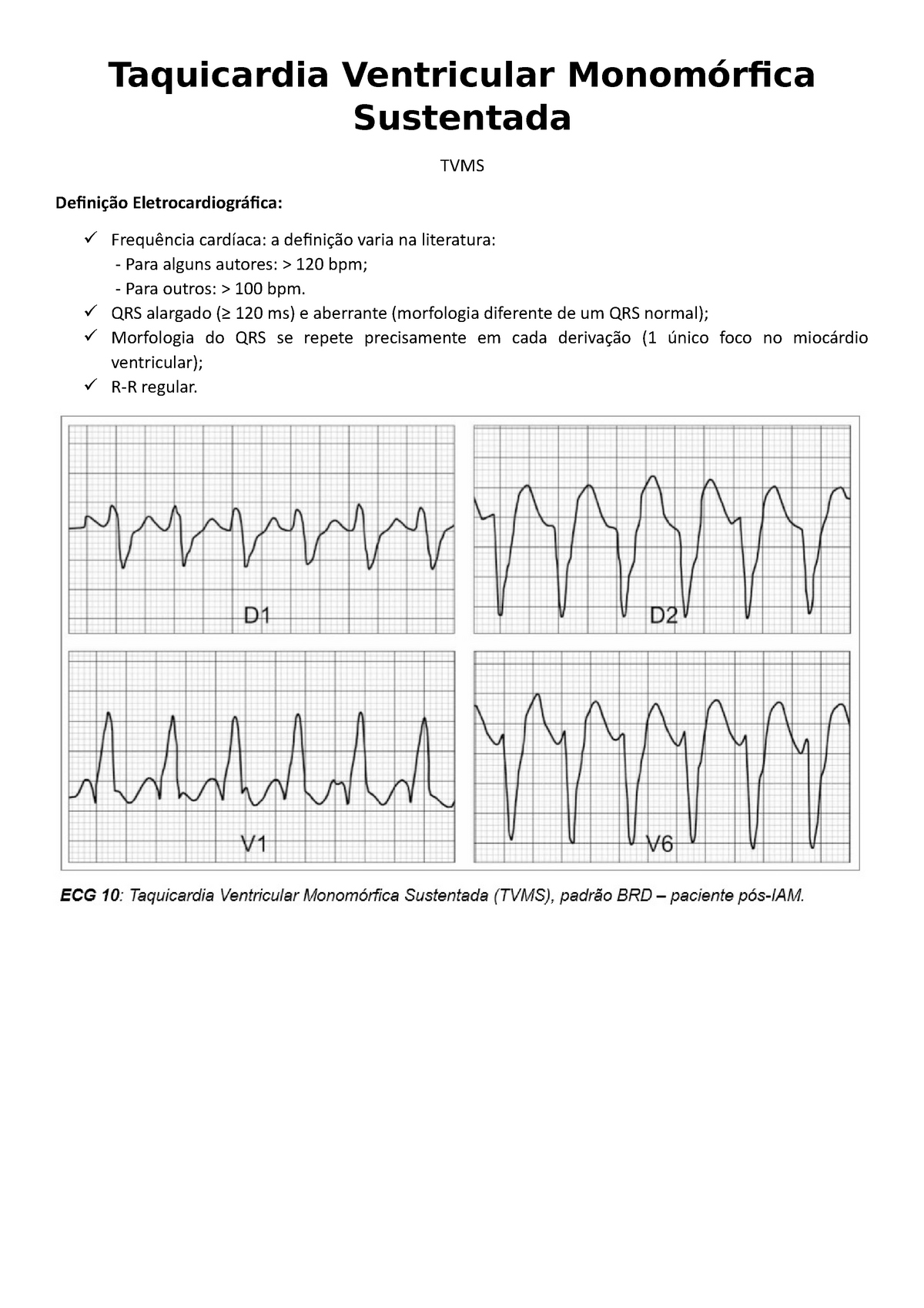 taquicardia ventricular polimórfica