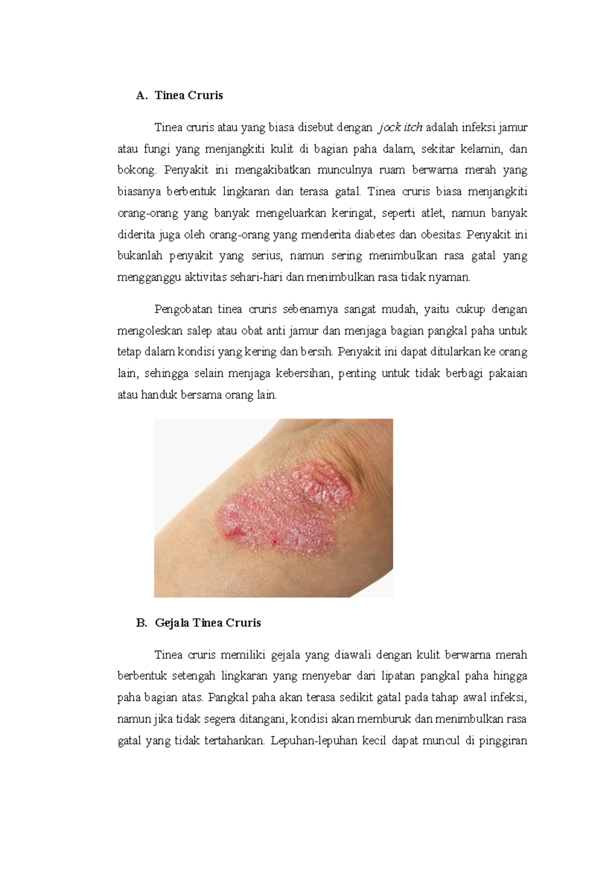 Tinea cruris Makalah A. Tinea Cruris Tinea cruris atau yang biasa