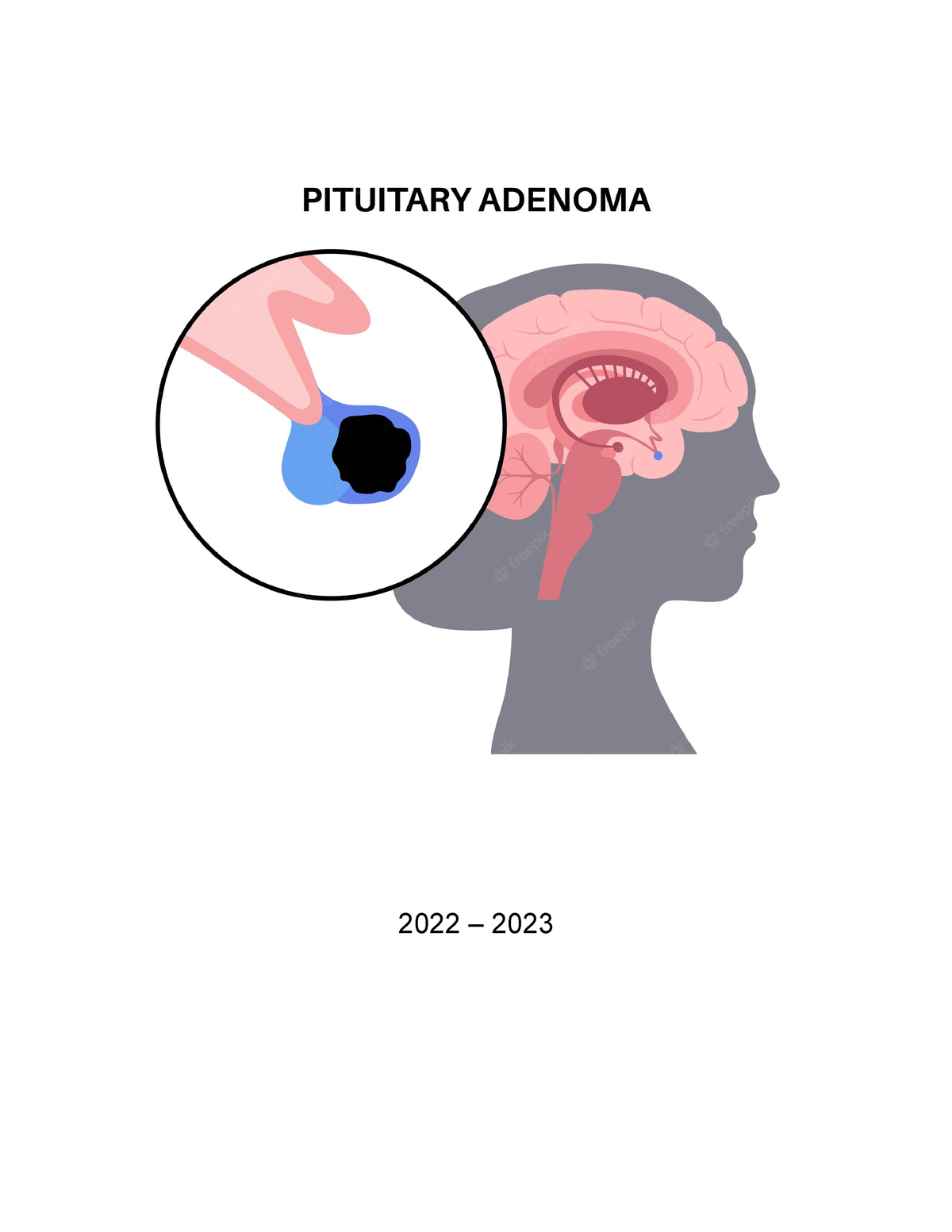 pituitary-adenoma-surgery