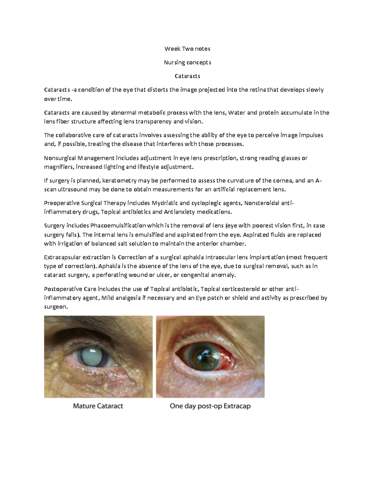 Week two notes Nursing concepts Cataracts Cataracts a condition of the eye that distorts the