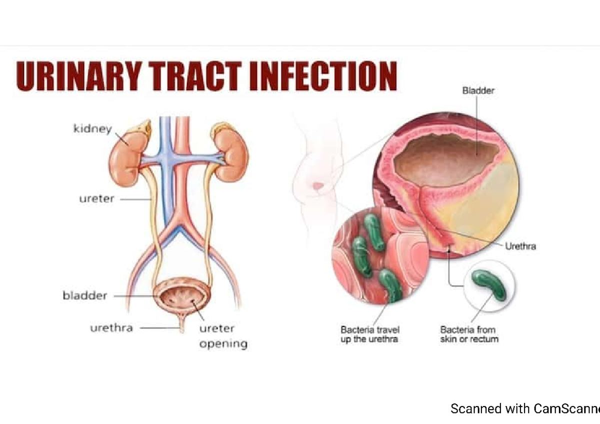 Urinary Tract Infection - Nursing - Studocu