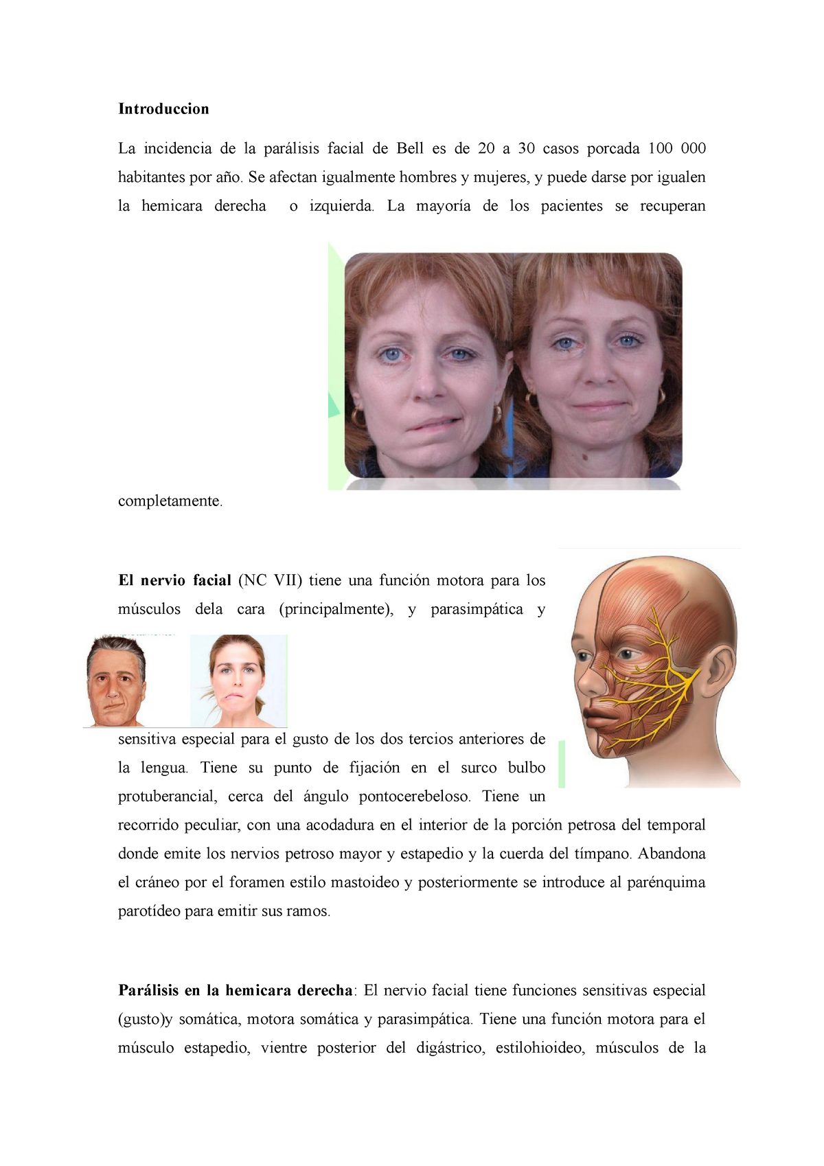 Caso Clinico Eeee Introduccion La Incidencia De La Parálisis Facial De Bell Es De 20 A 30 6723