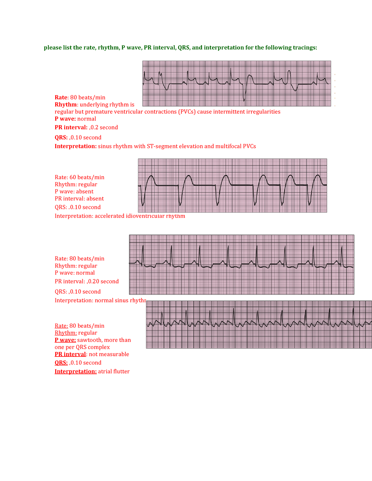 ECG - Interpretation - please list the rate, rhythm, P wave, PR ...