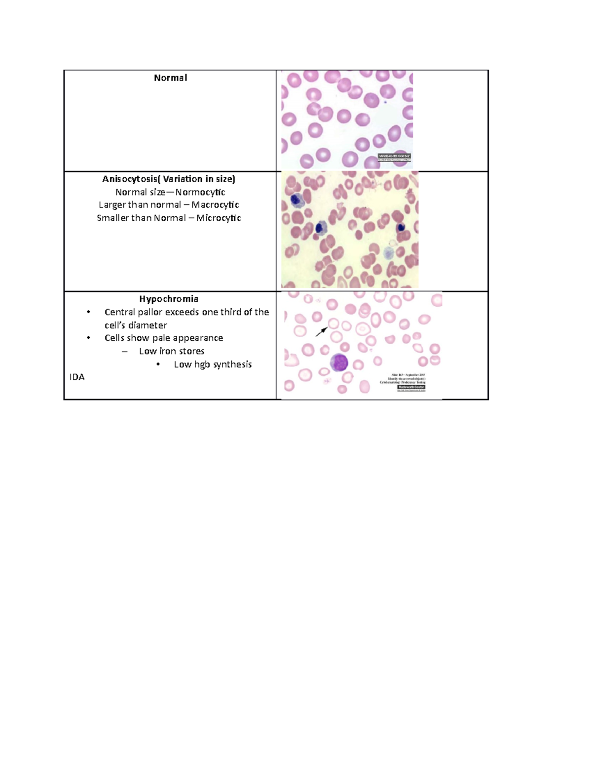 Hematology for MLT Normal Anisocytosis( Variation in size) Normal