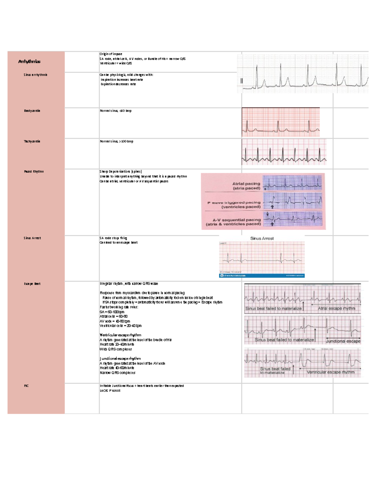 EKG abnormals - EKG abnormalities chart - Origin of impuse SA node ...