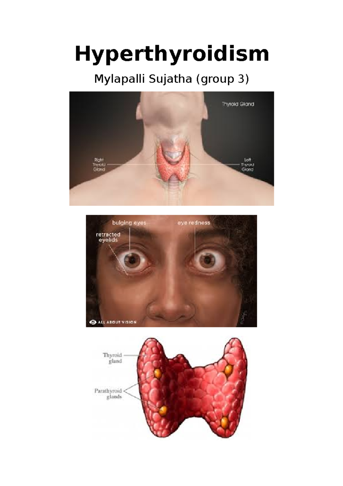 Hyperthyroidism - seminar topic - Hyperthyroidism Mylapalli Sujatha ...