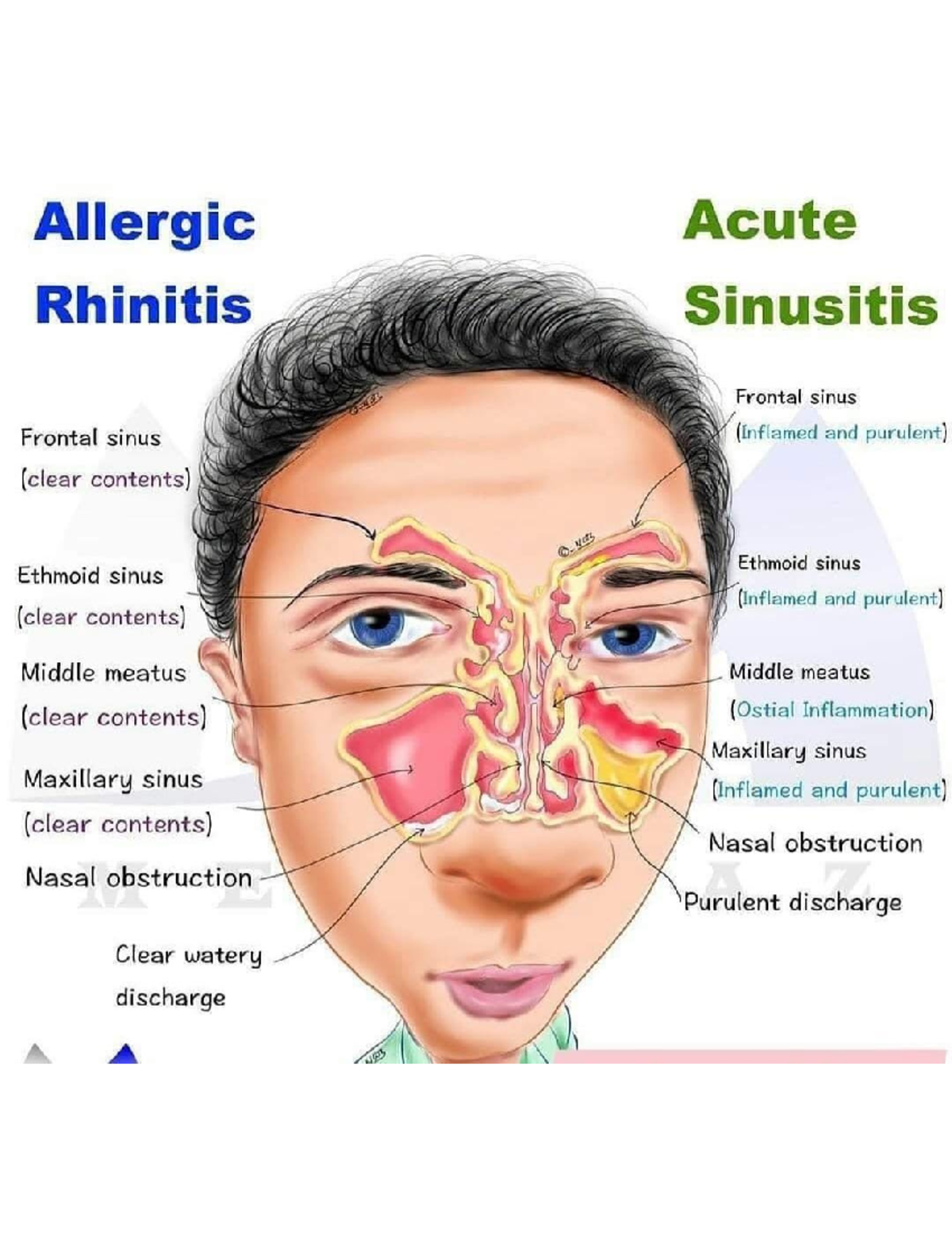 Allergic rhinitis vs acute sinusitis - Allergic Acute Rhinitis ...