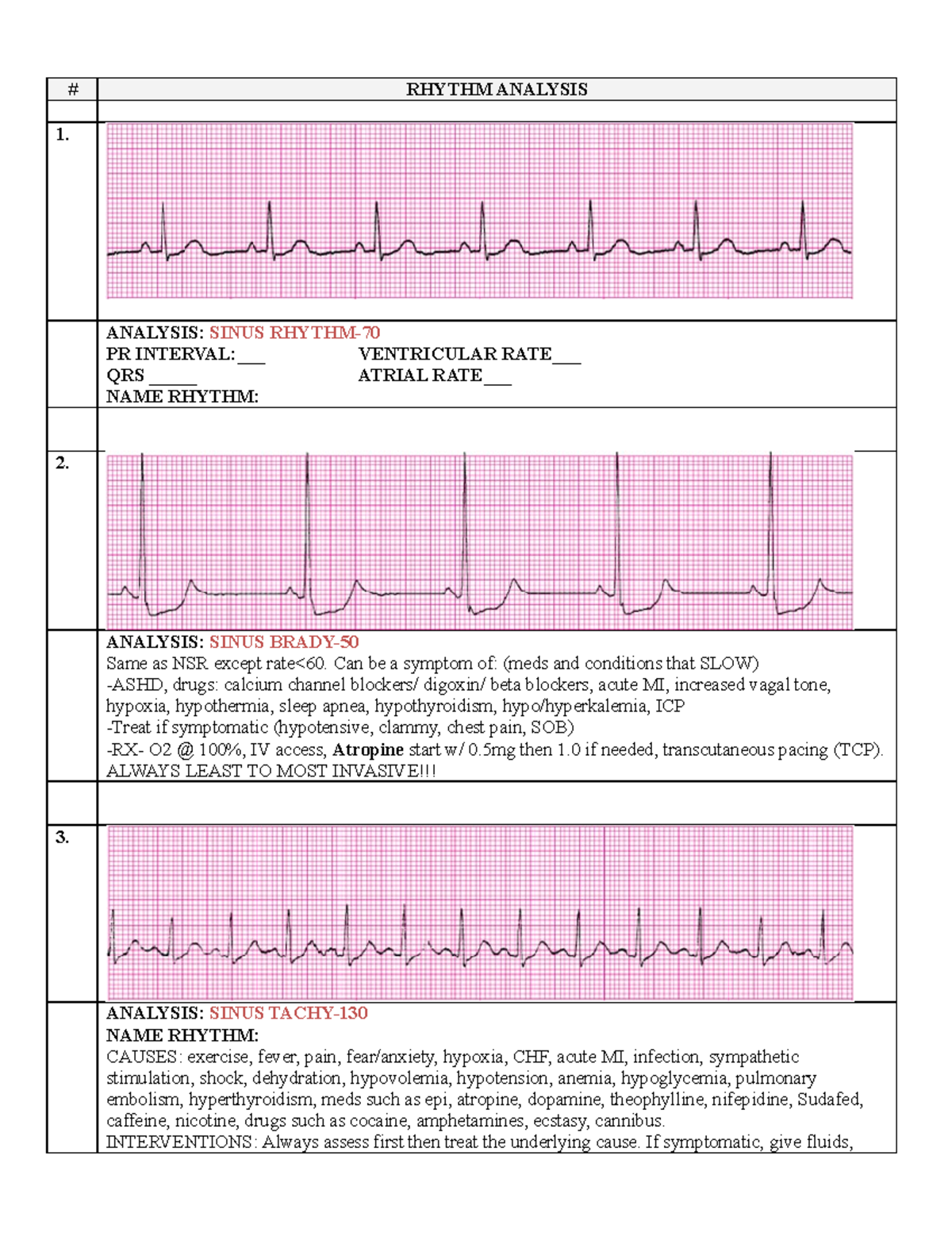 EKG updated - # RHYTHM ANALYSIS 1. ANALYSIS: SINUS RHYTHM- PR INTERVAL ...