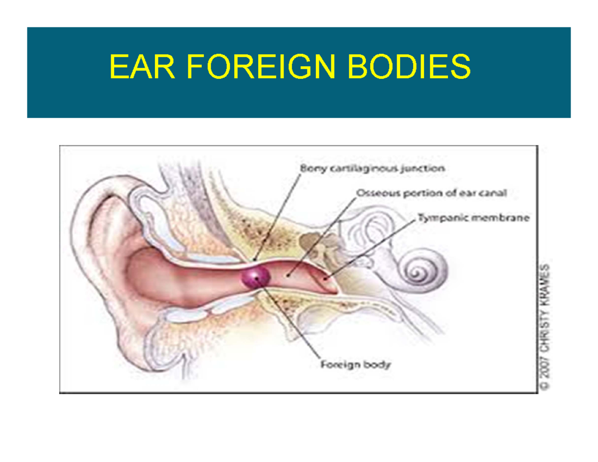 Foreignbody in ear:-Condition where something is present in the ear ...