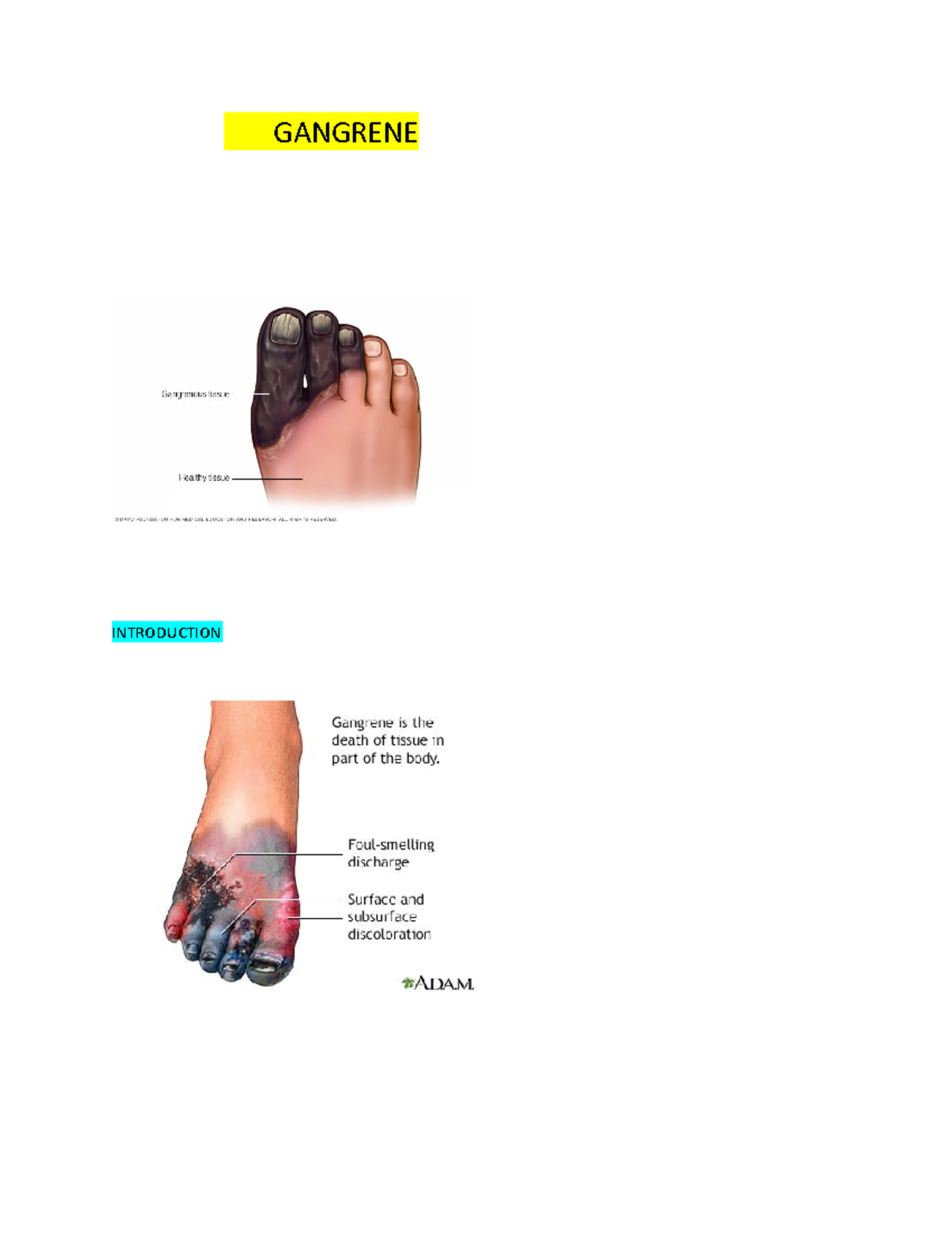 GangreneWPS Office Lecture notes GANGRENE INTRODUCTION Gangrene is