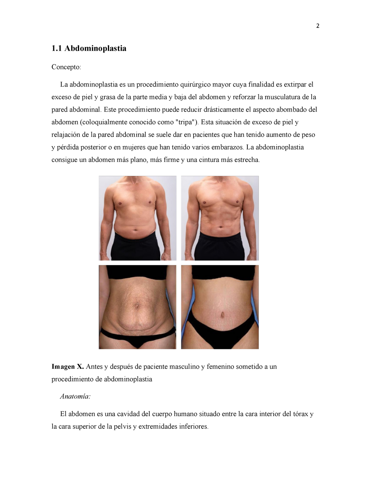 Manual de Cirugía plástica detallada - 1 Abdominoplastia Concepto: La  abdominoplastia es un - Studocu