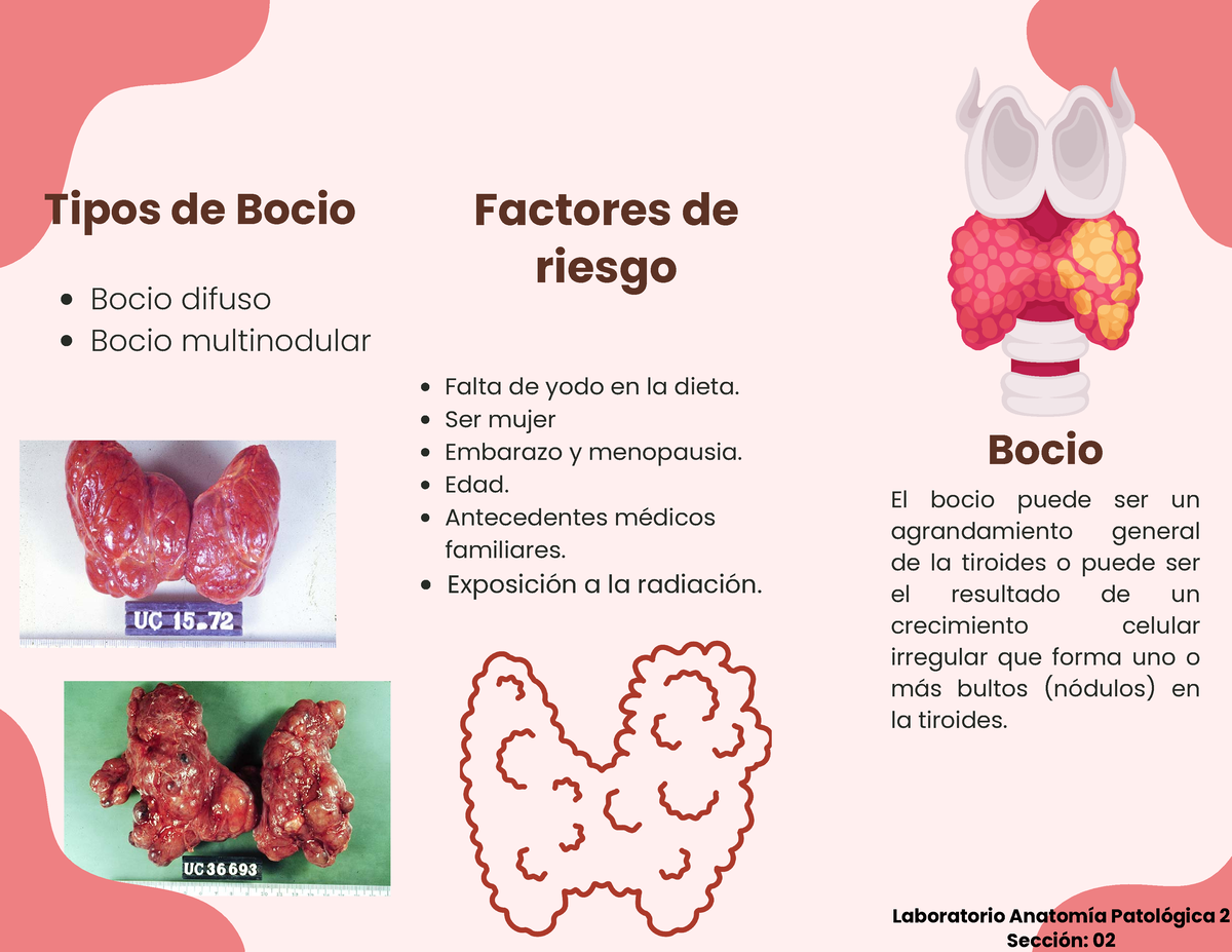 Brochure De Bocio - Factores De Riesgo Tipos De Bocio Bocio Difuso ...