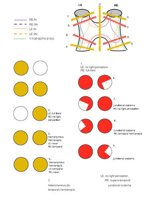 Visual Pathway & Visual Field Defects - THE VISUAL PATHWAY PRECHIASMAL ...