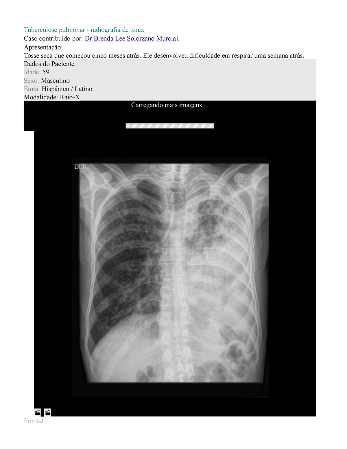 Tuberculose pulmonar - Aula - Tuberculose pulmonar - radiografia de tórax  Caso contribuído por: Dr - Studocu