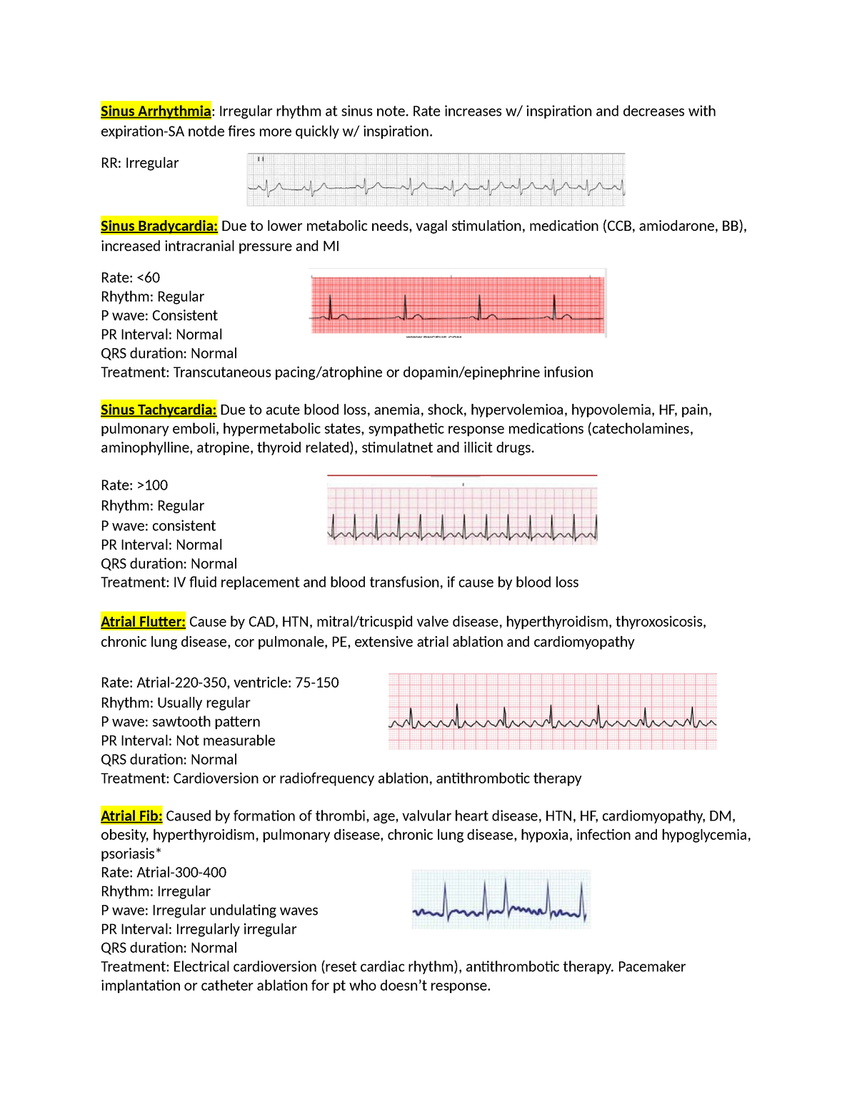 ECG - Different types of ECG - Sinus Arrhythmia: Irregular rhythm at ...