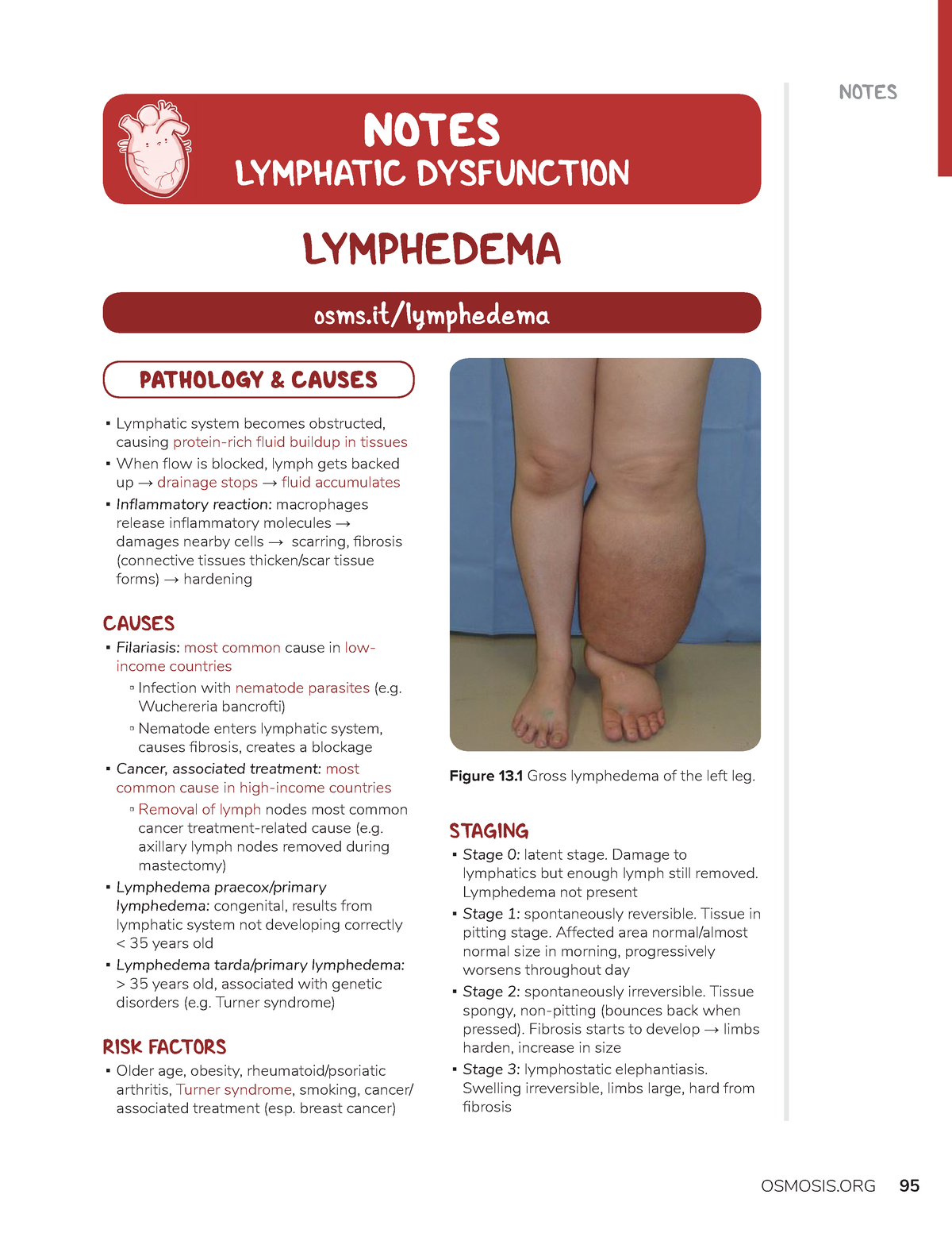 Lymphatic Disfunction Osmosis Notes 95 Figure 13 Gross Lymphedema Of The Left Leg Osms