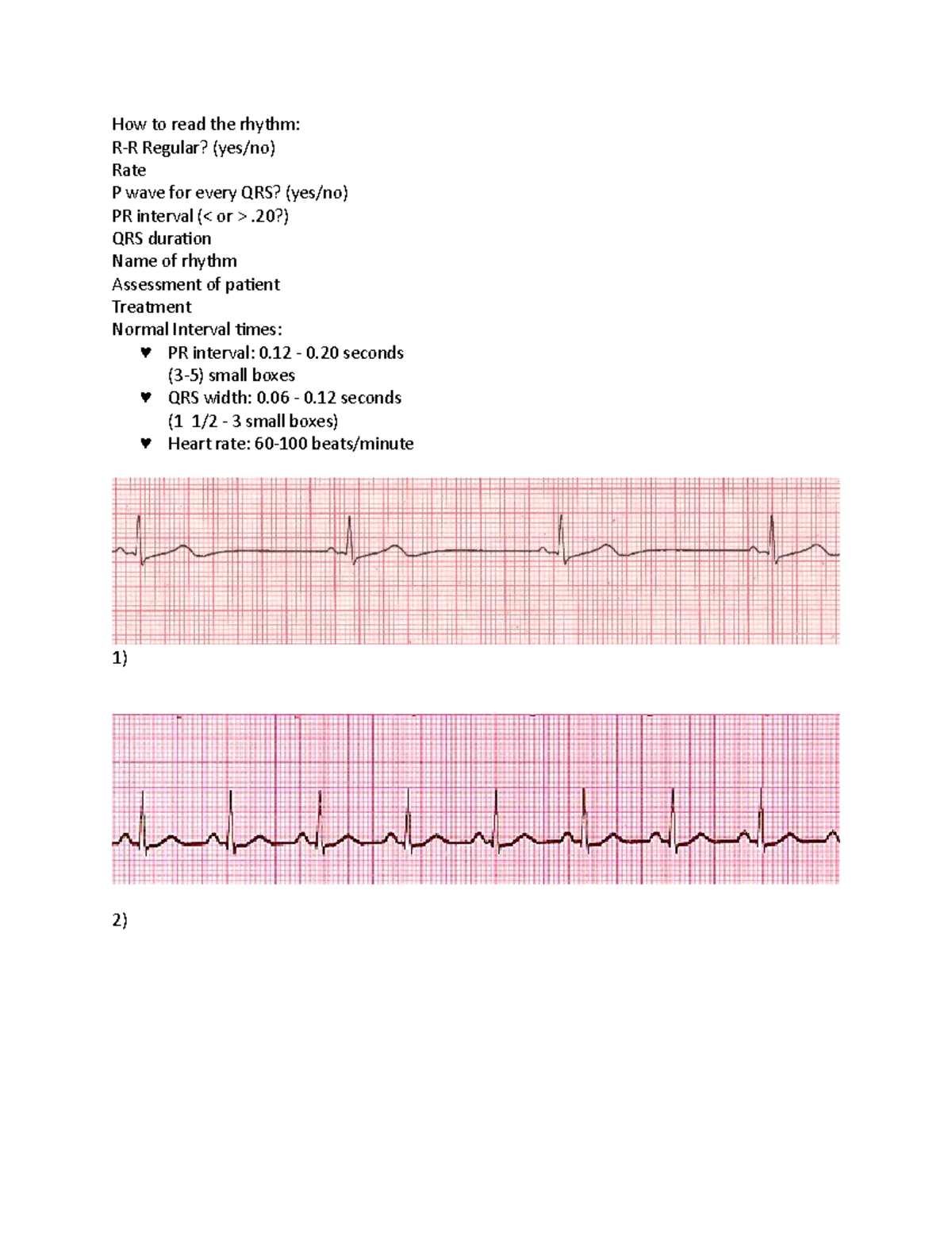 EKG Practice - How to read the rhythm: R-R Regular? (yes/no) Rate P ...