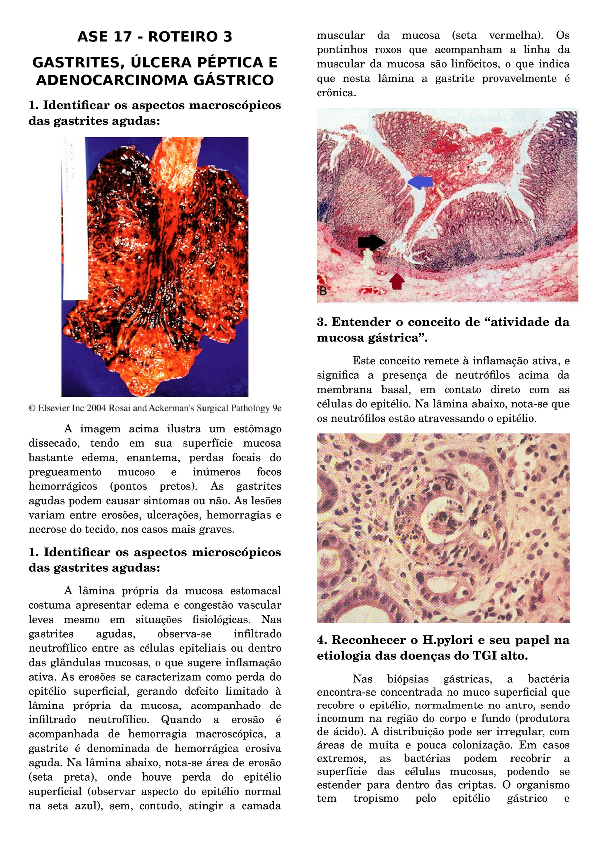 Gastrites Ulceras Pepticas E Adenocarcinoma Gastrico Studocu