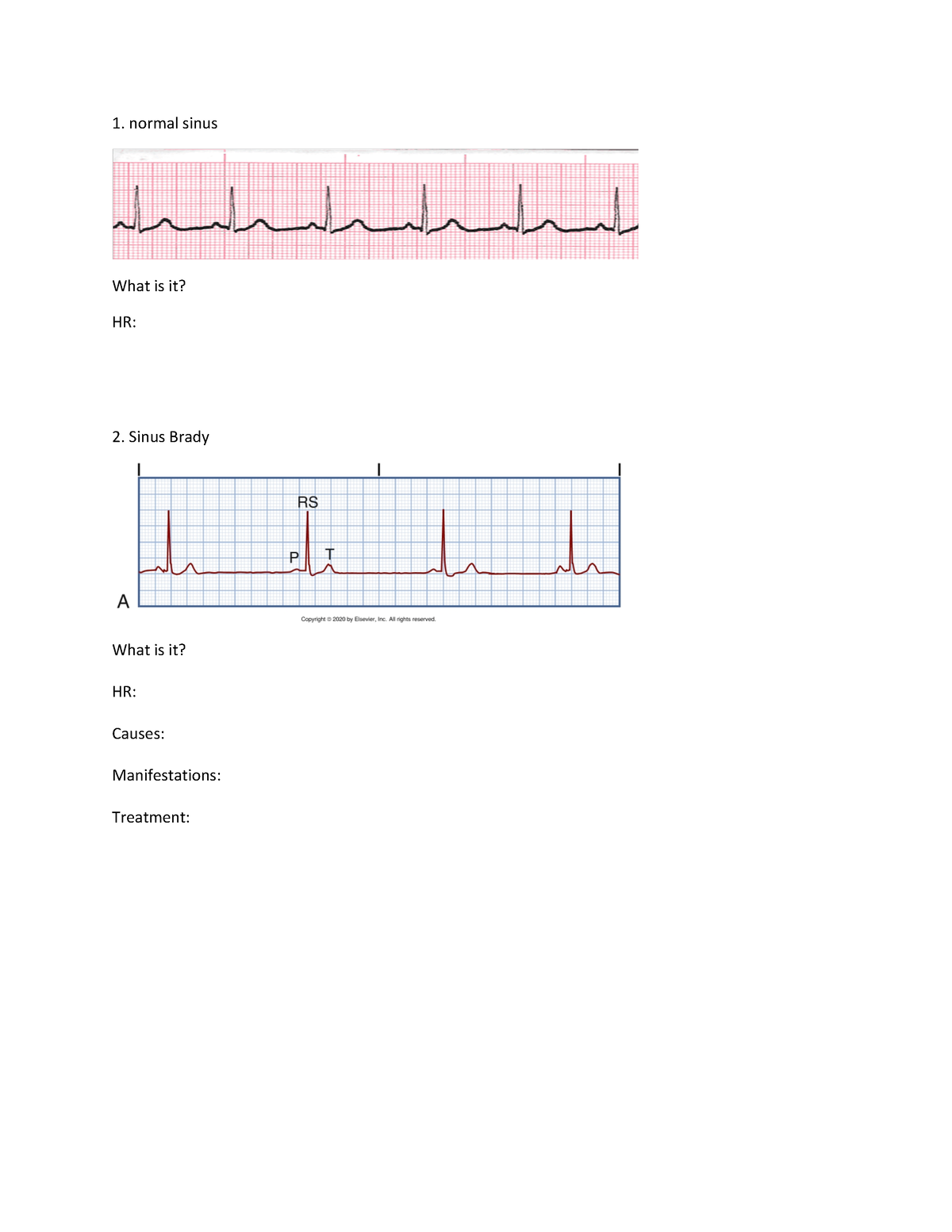 Dysrhythmias Practice - normal sinus What is it? HR: Sinus Brady What ...