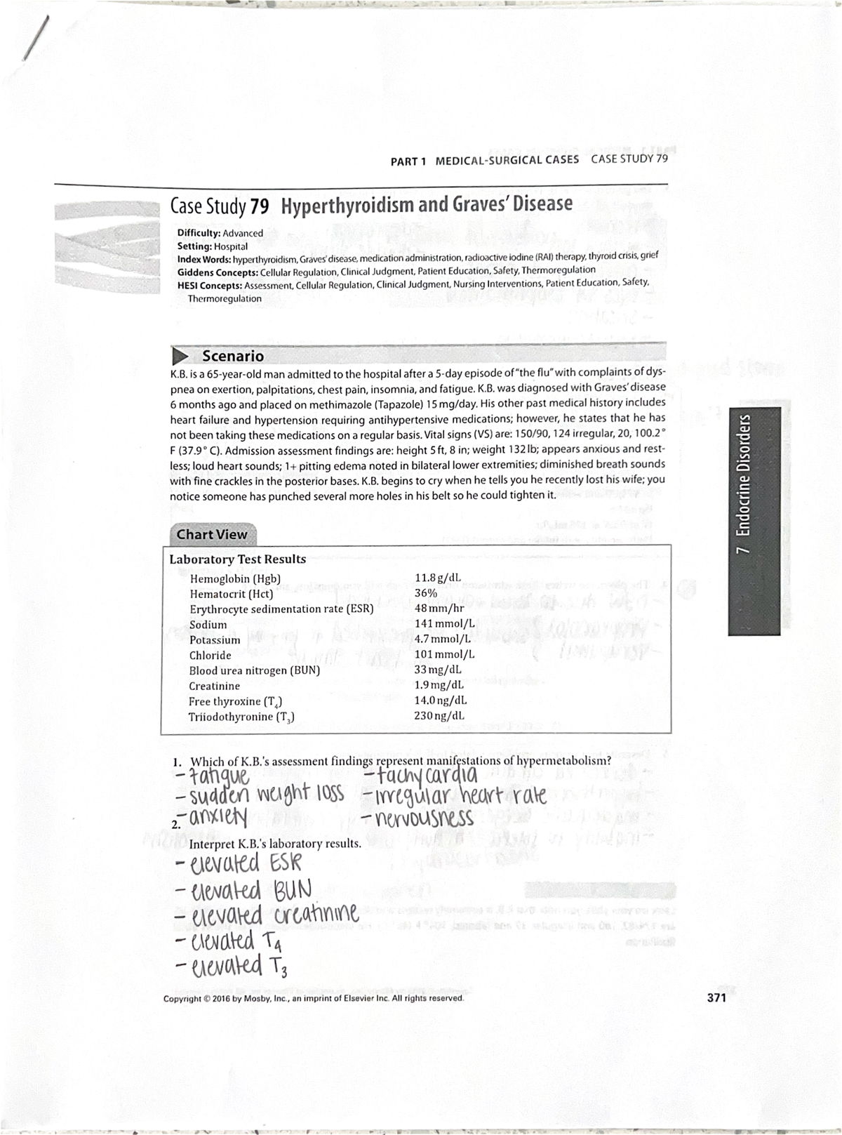 case study of hyperthyroidism