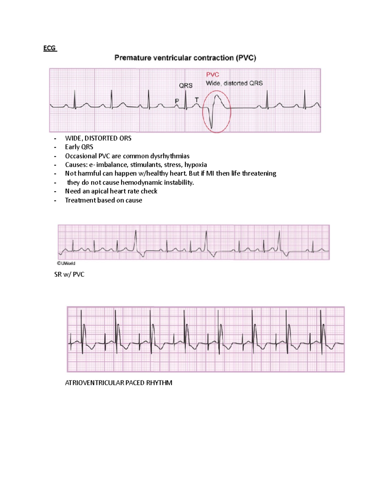 Uworld flash notes NURSING - ECG - WIDE, DISTORTED ORS Early QRS ...