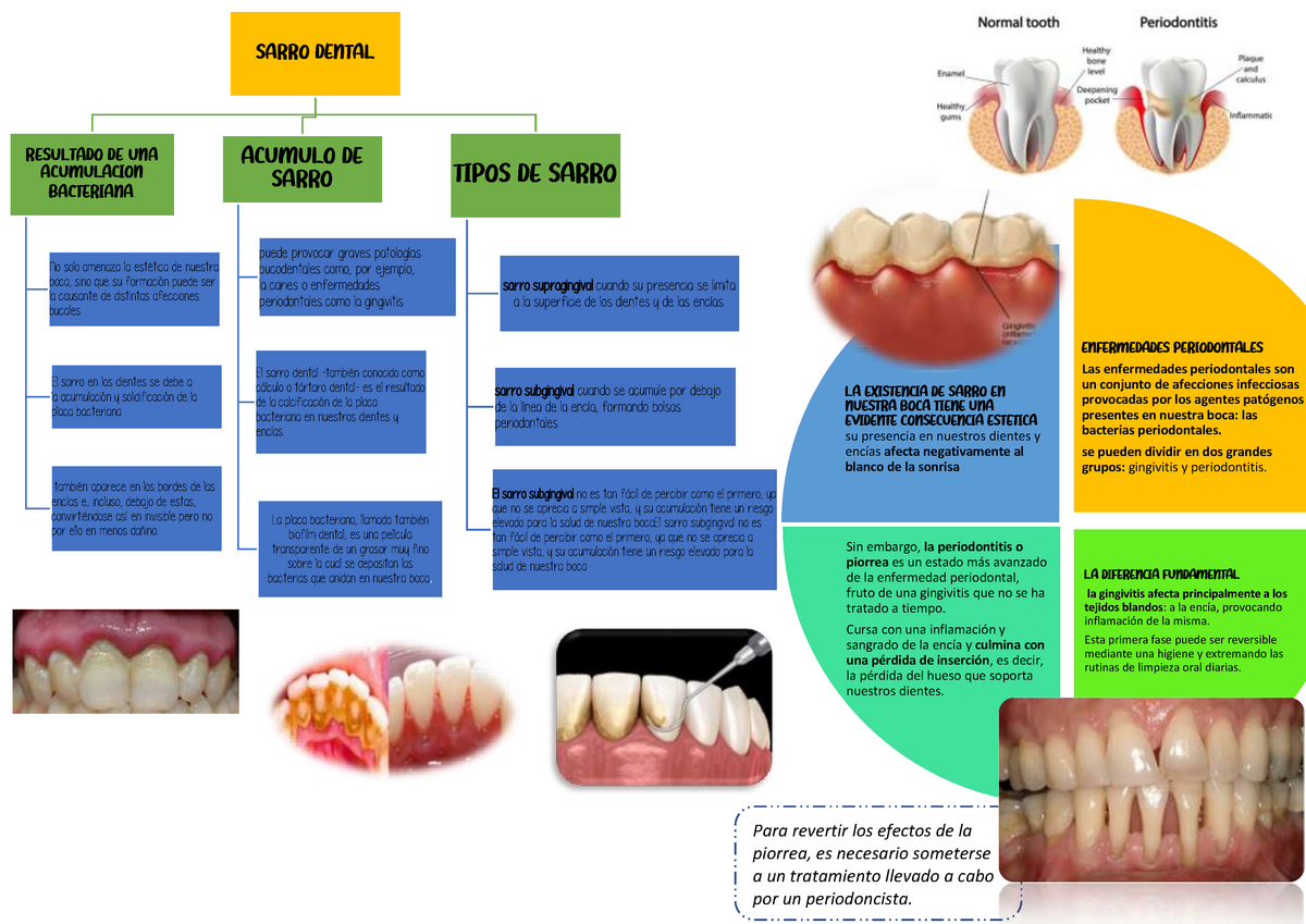 Sarro En Piezas Dentarias - SARRO DENTAL TIPOSDE SARRO Sarro ...