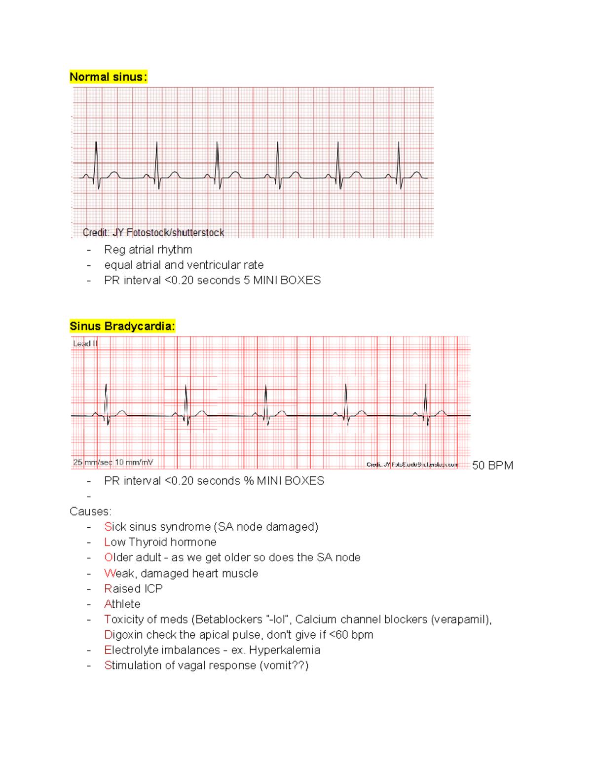 Exam 2 med surg cardiac notes - Normal sinus: Reg atrial rhythm equal ...