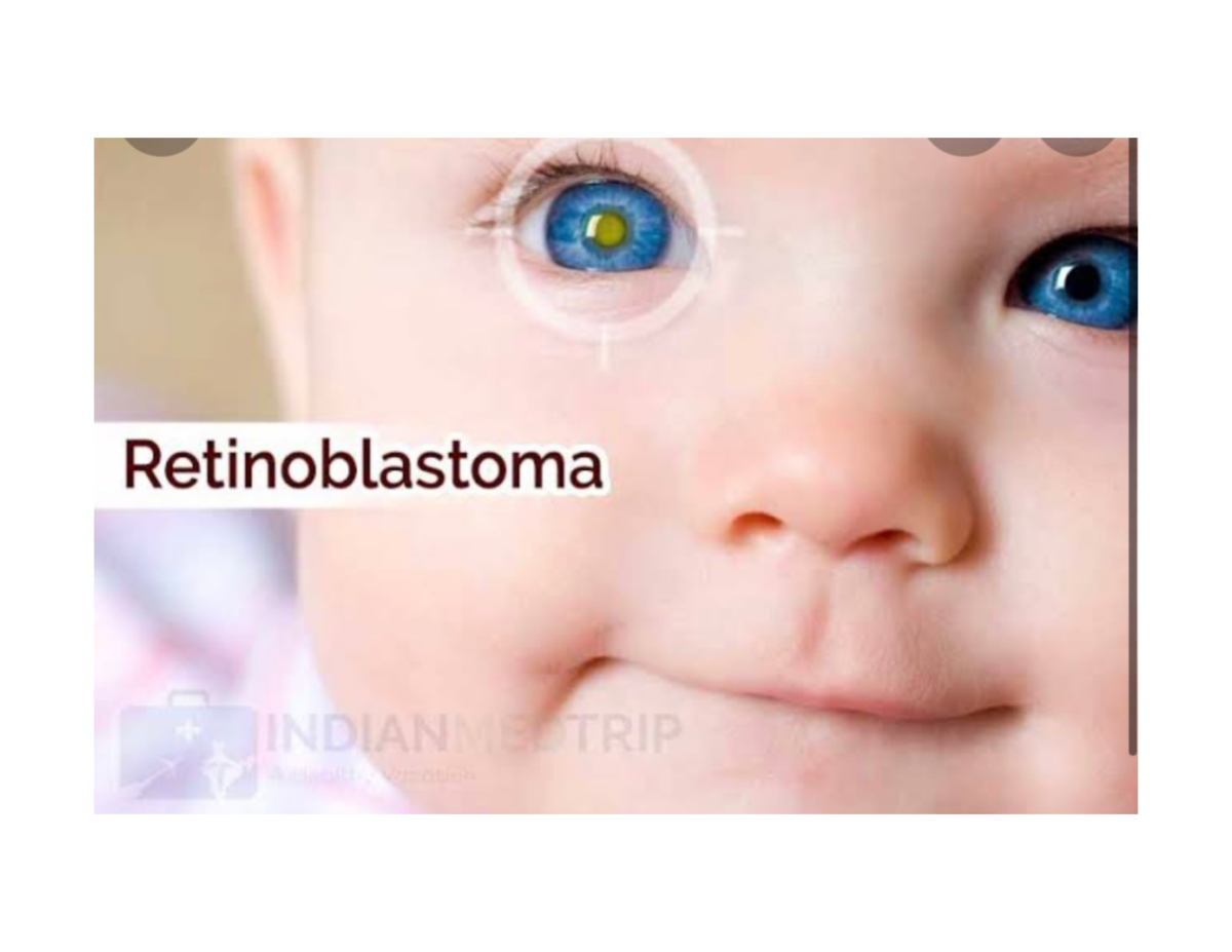 Retinoblastoma eye cancer Bsc.optometry Studocu
