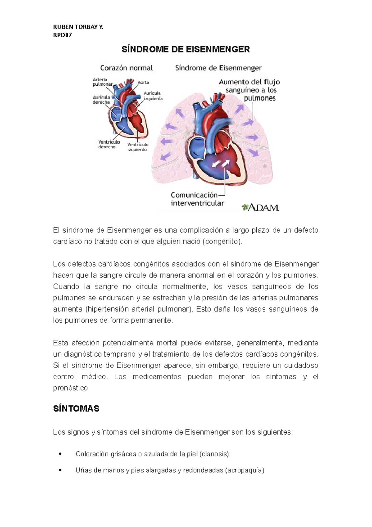 Síndrome DE Eisenmenger - RPD SÍNDROME DE EISENMENGER El síndrome de ...