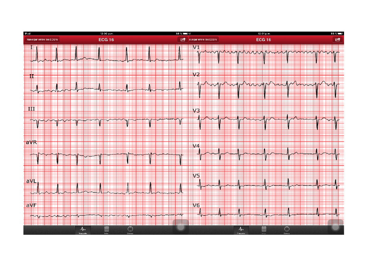 Electro cardiograma - Descripción ritmo de base: ritmo irregular de QRS ...
