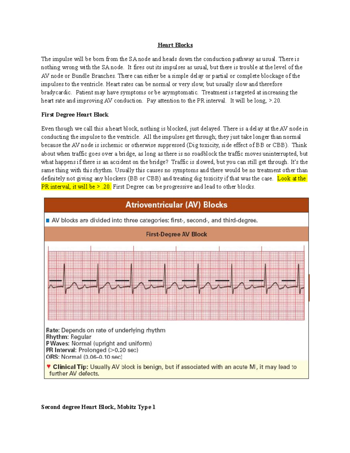 Heart Blocks Heart Blocks The impulse will be born from the SA node