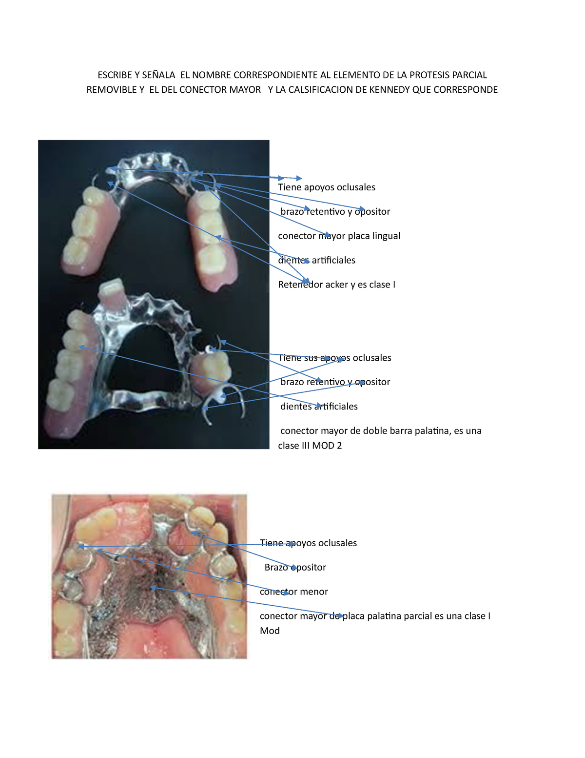 Tarea Elementos De La Protesis Removible 1 Escribe Y SeÑala El Nombre Correspondiente Al 0439