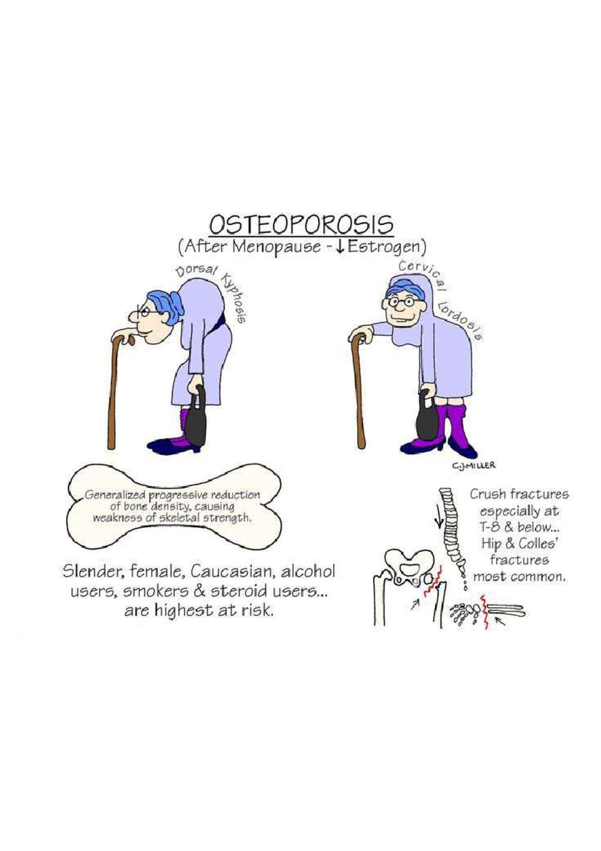 Nclex osteoporosis - NSG-2104 - Studocu