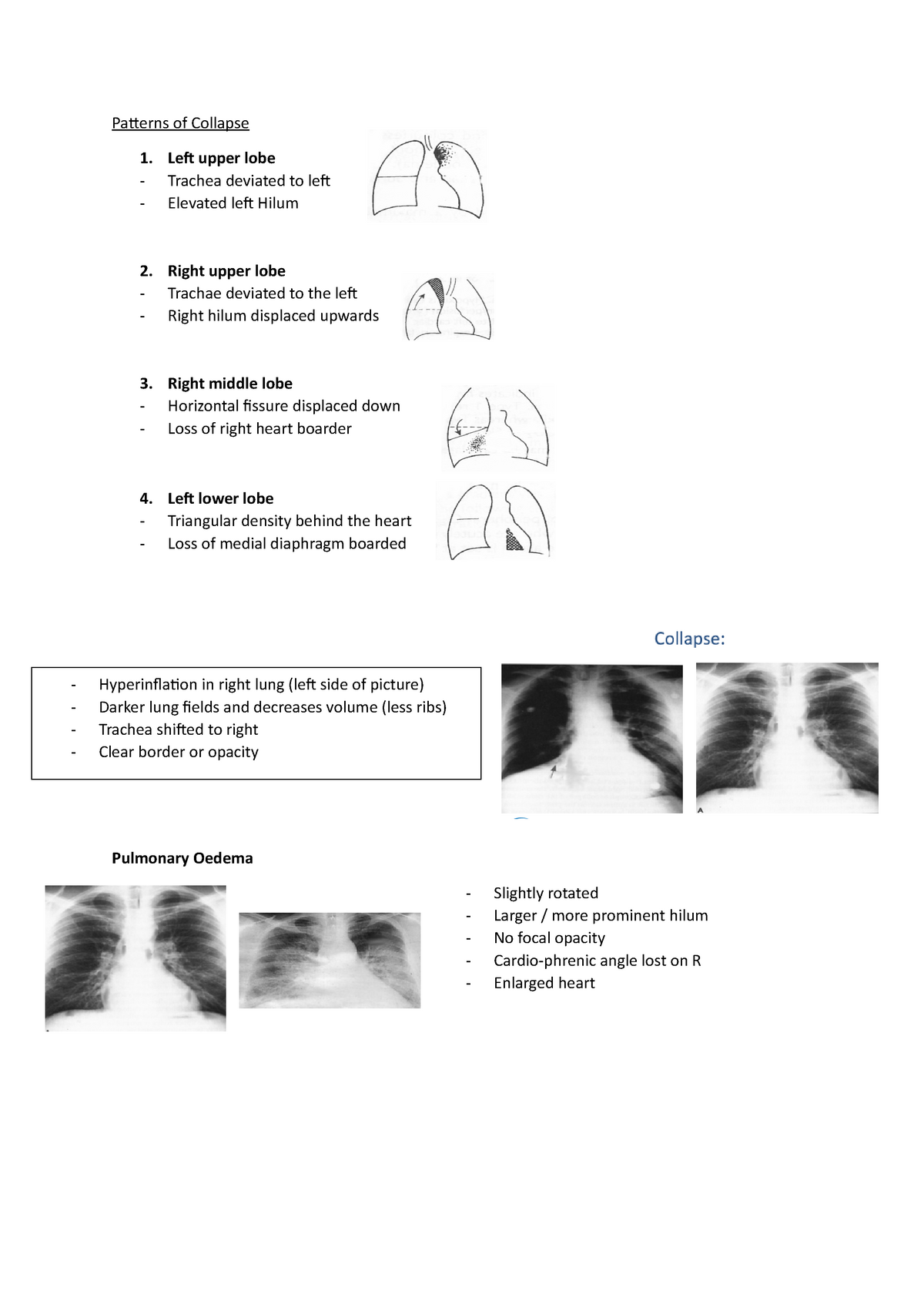 Lung collapse - Pictures and x-rays - Patterns of Collapse 1. Left ...