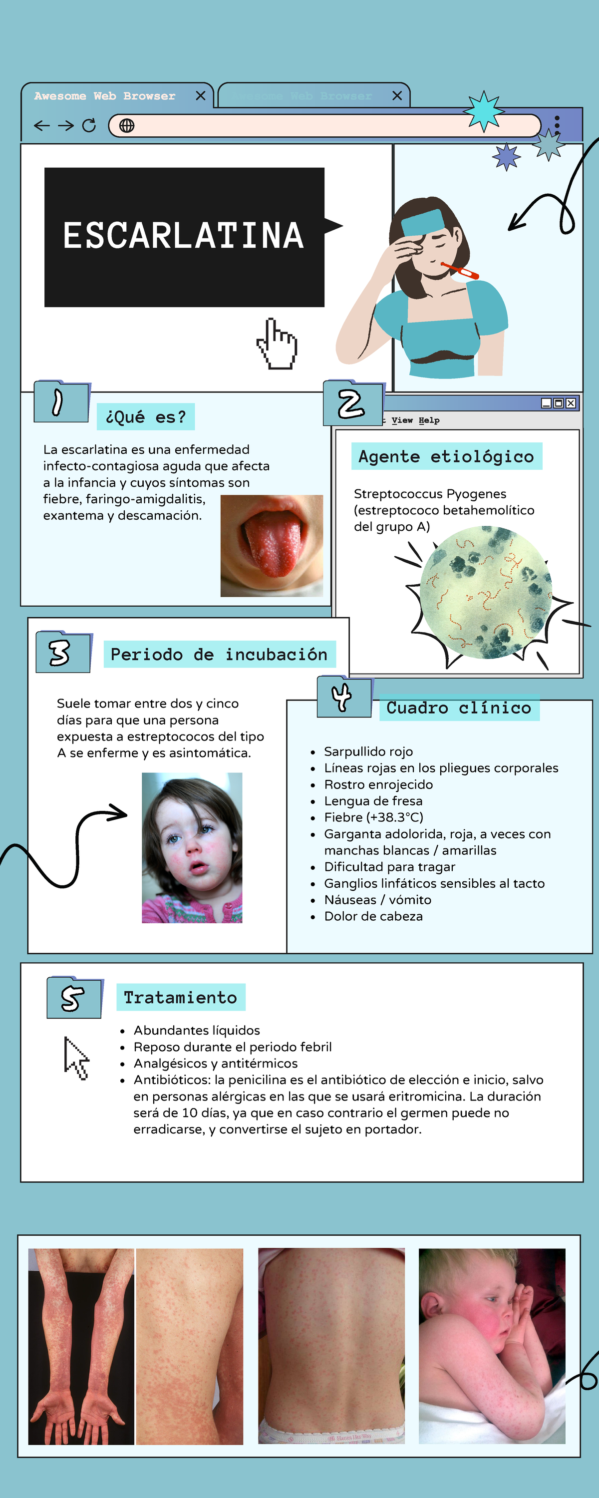 Escarlatina - Agente etiológico Streptococcus Pyogenes (estreptococo ...