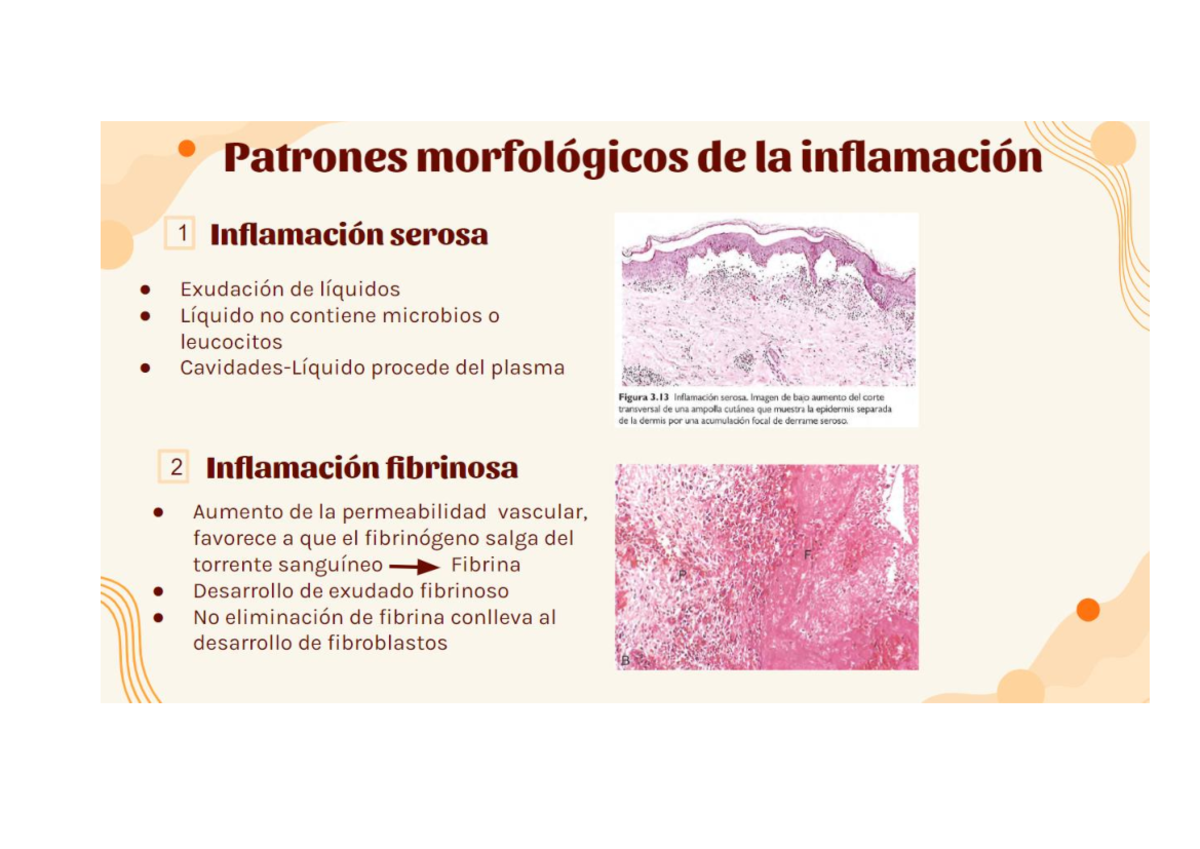 Patrones Morfologicos De La Inflamación - Patología - Studocu