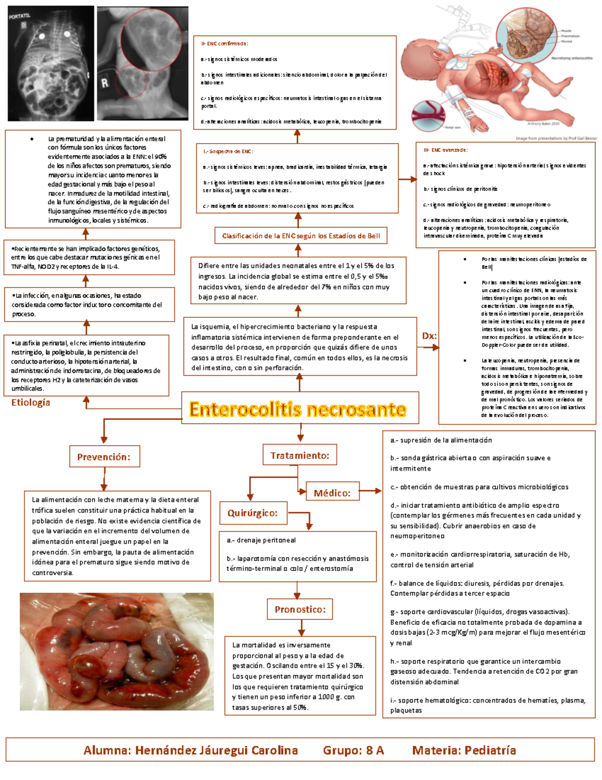 Enterocolitis necrotizante Carolina 8A - La isquemia, el ...