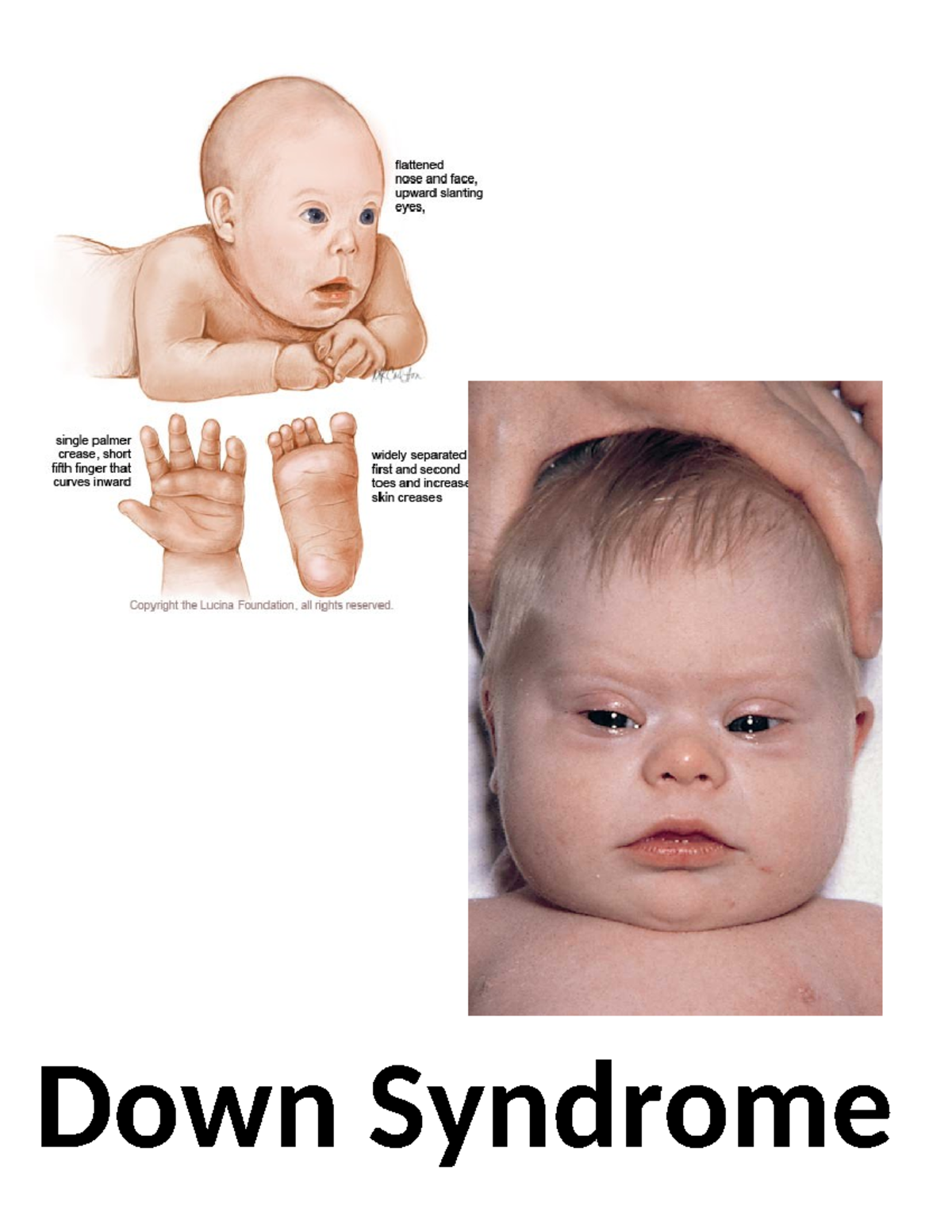 Genetic Disorders - assignment - Down Syndrome Turner Syndrome Cystic ...